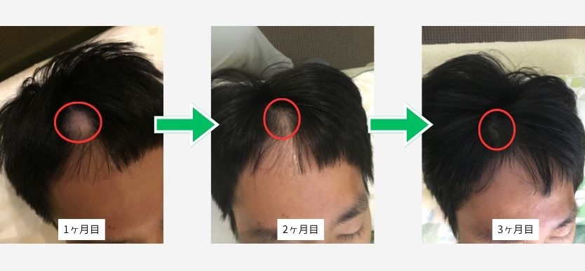 初回-三か月目
