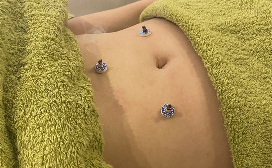 間接灸を用いた施術の様子